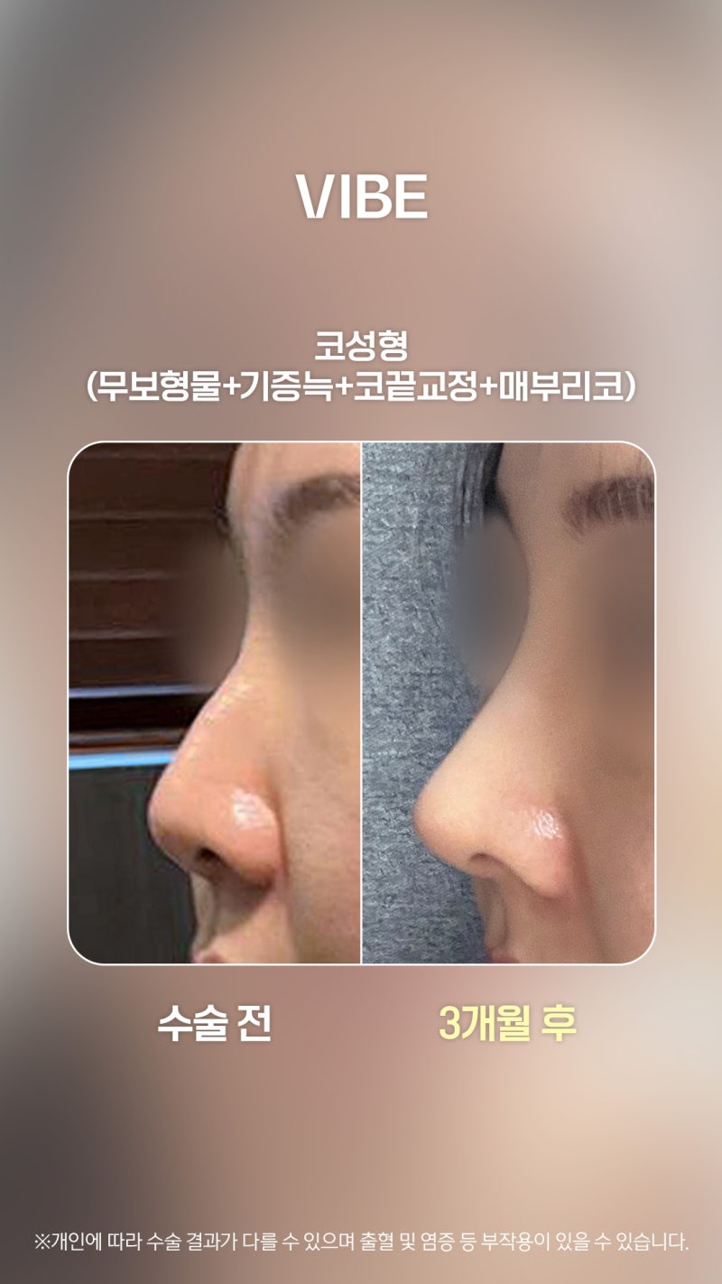 처진 매부리코, 보형물 사용없이 단연코로 예쁘게 오똑!