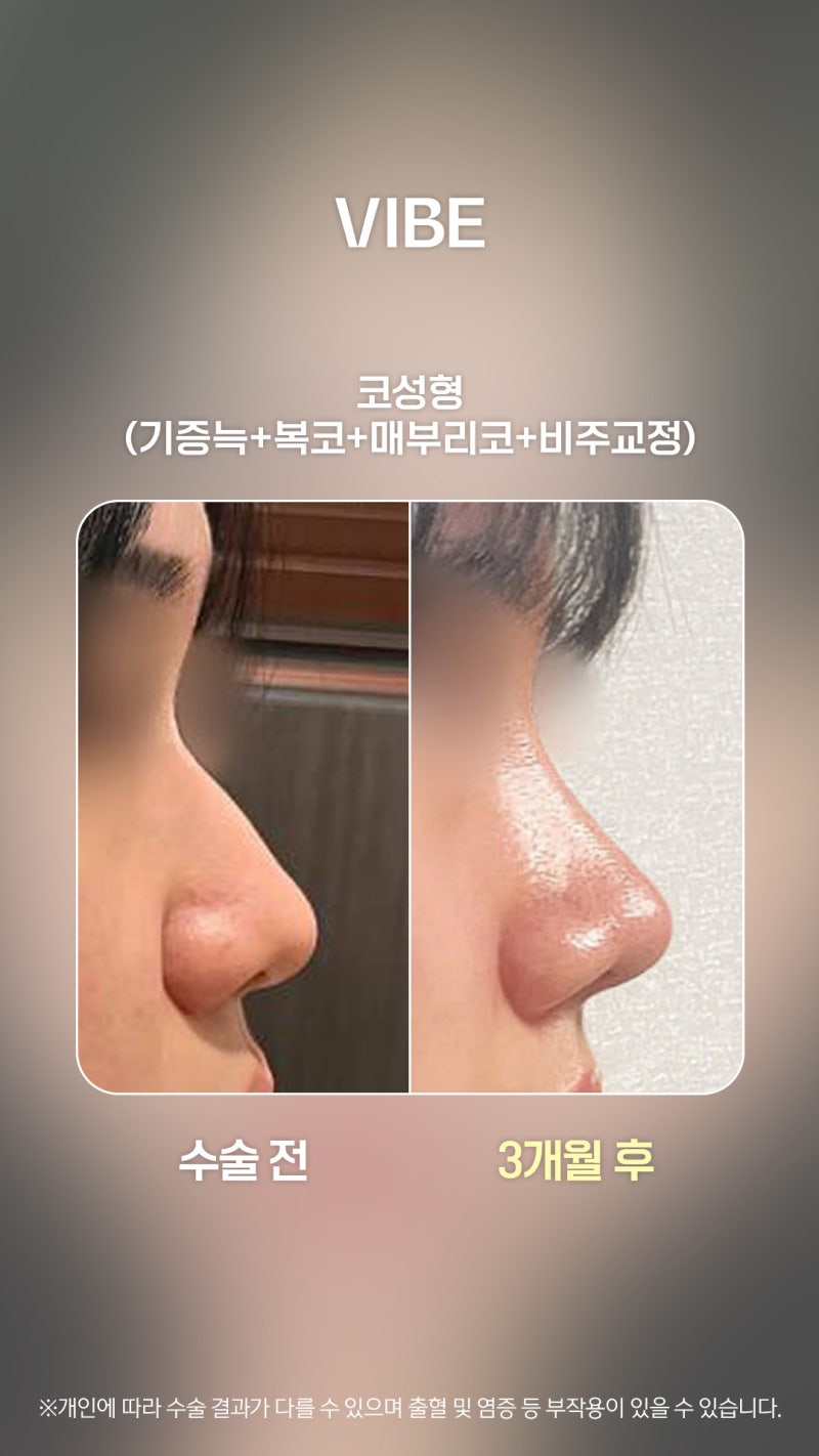 뭉툭했던 복코, 자려한 직반라인으로!