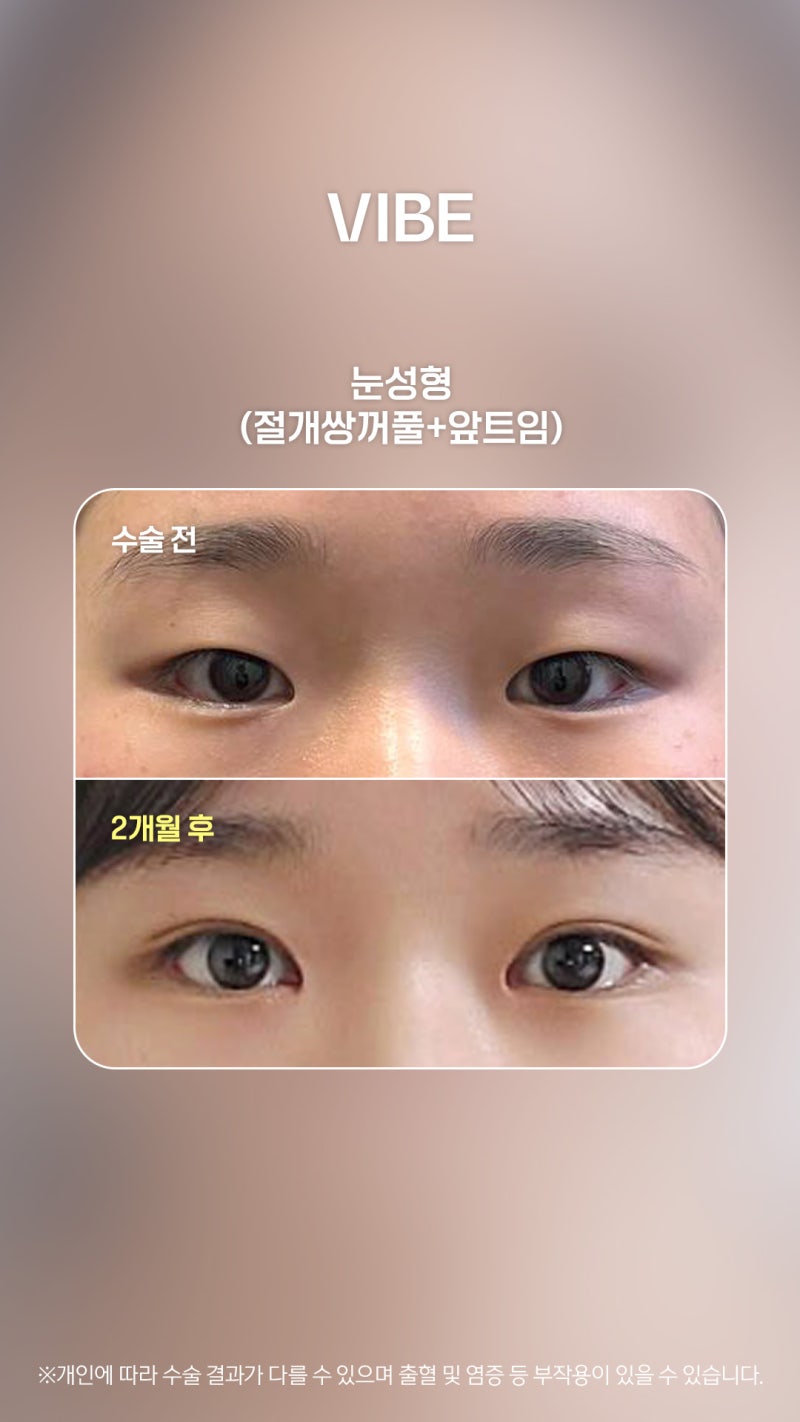 답답해보이는 외꺼풀? 절개쌍꺼풀+앞트임으로 트여보이게!