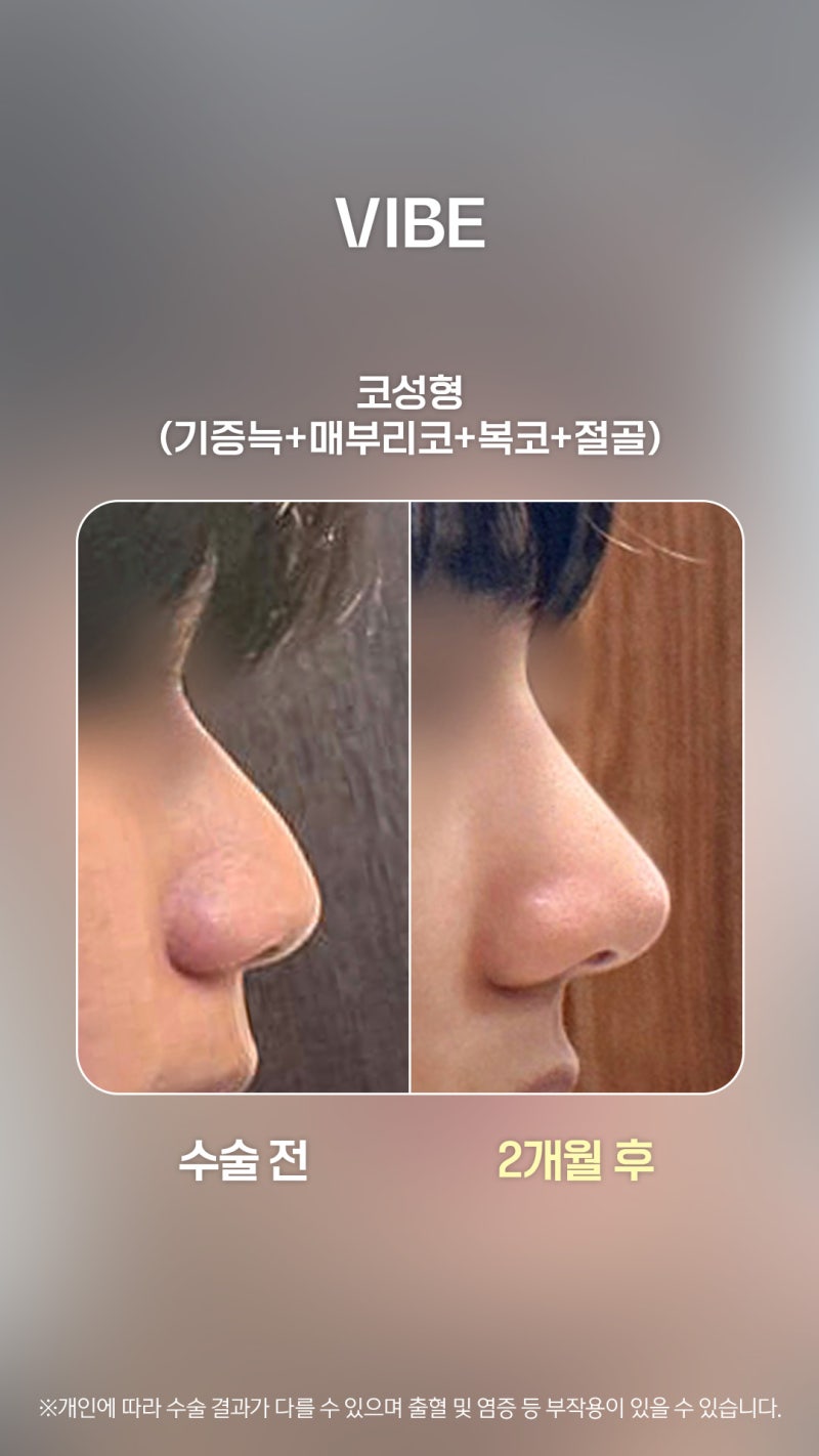 직선라인으로 수술한 남자코성형 사례