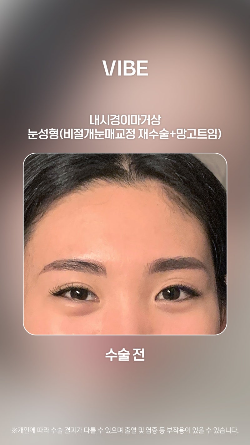 Improve Heavy and Undefined Eyes with Endoscopic Forehead Lift and Ptosis Correction