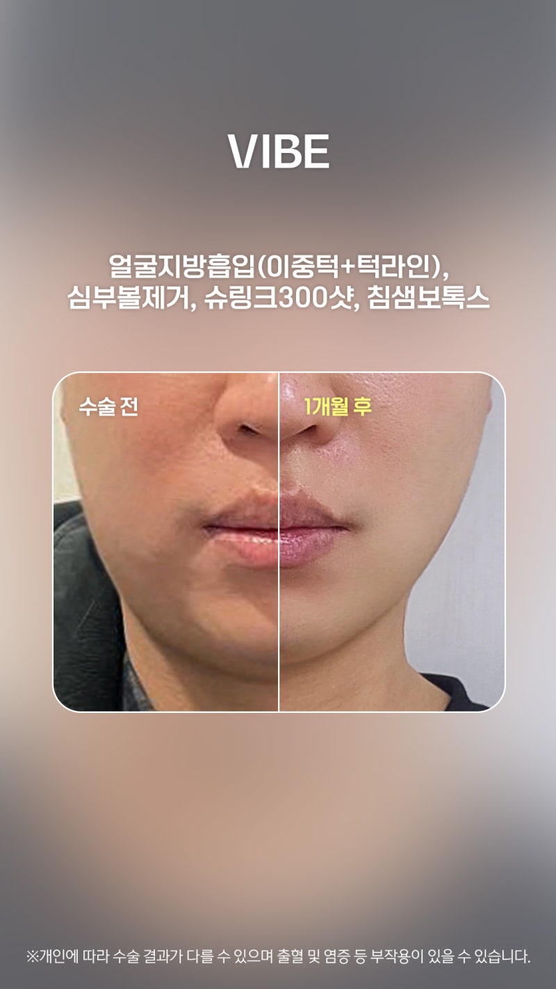 ดูดไขมันหน้าผู้ชาย กำจัดไขมันอย่างละเอียดด้วย LSSA