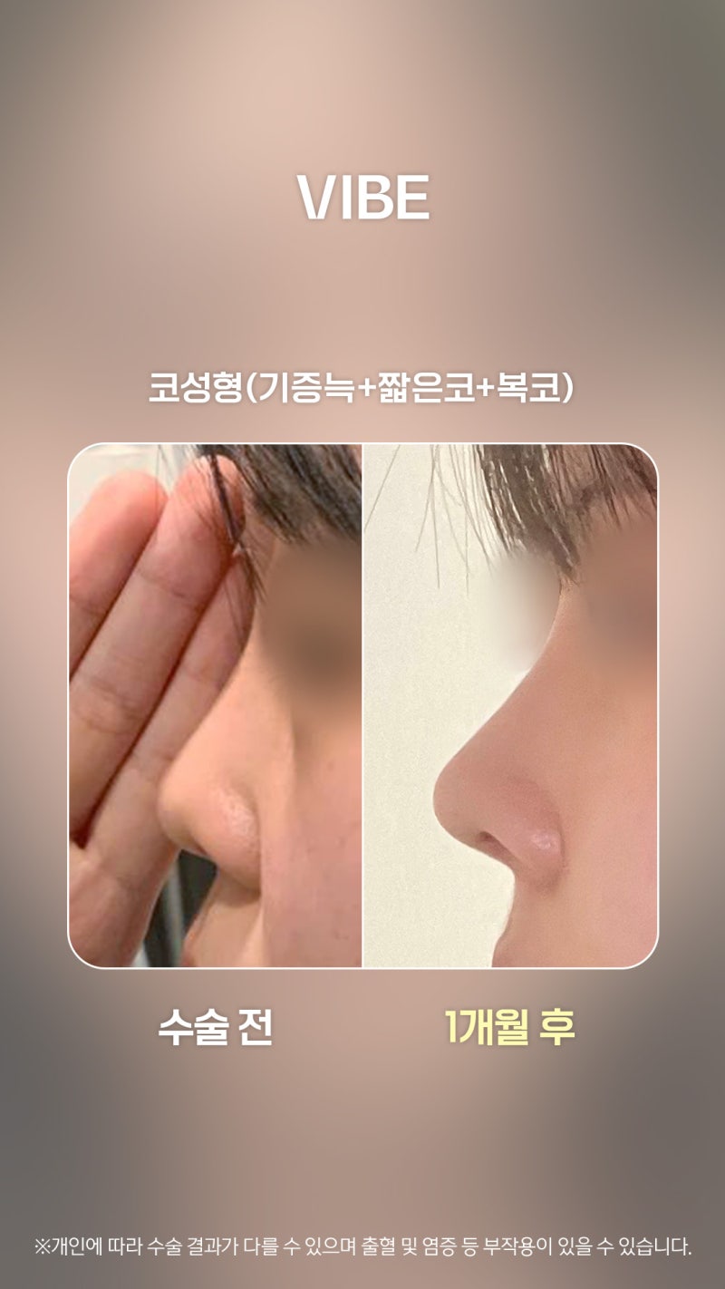 낮고 짧은코, 예쁘면서 자연스러운 코로!