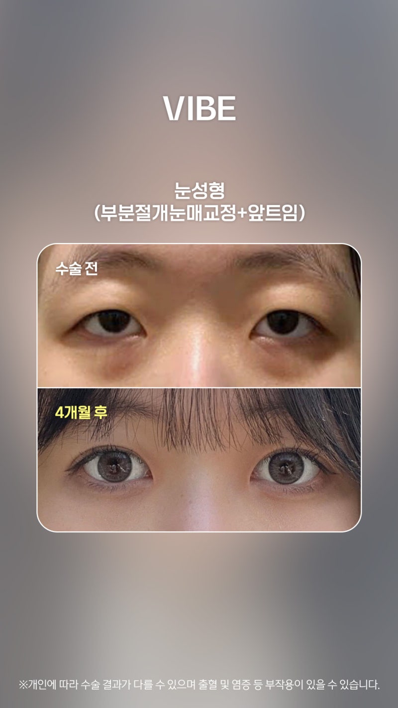 졸린 눈 고민이라면? 눈매교정으로 또렷하게 개선해보아요~