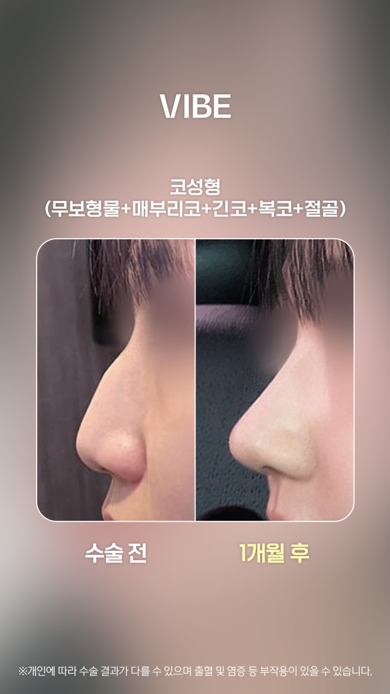 จมูกฮัมพ์ที่ไม่แบน! ปรับทรงจมูกให้โด่งสวยด้วยเทคนิค ‘ทันยอนโค’ โดยไม่ใช้ซิลิโคน :)