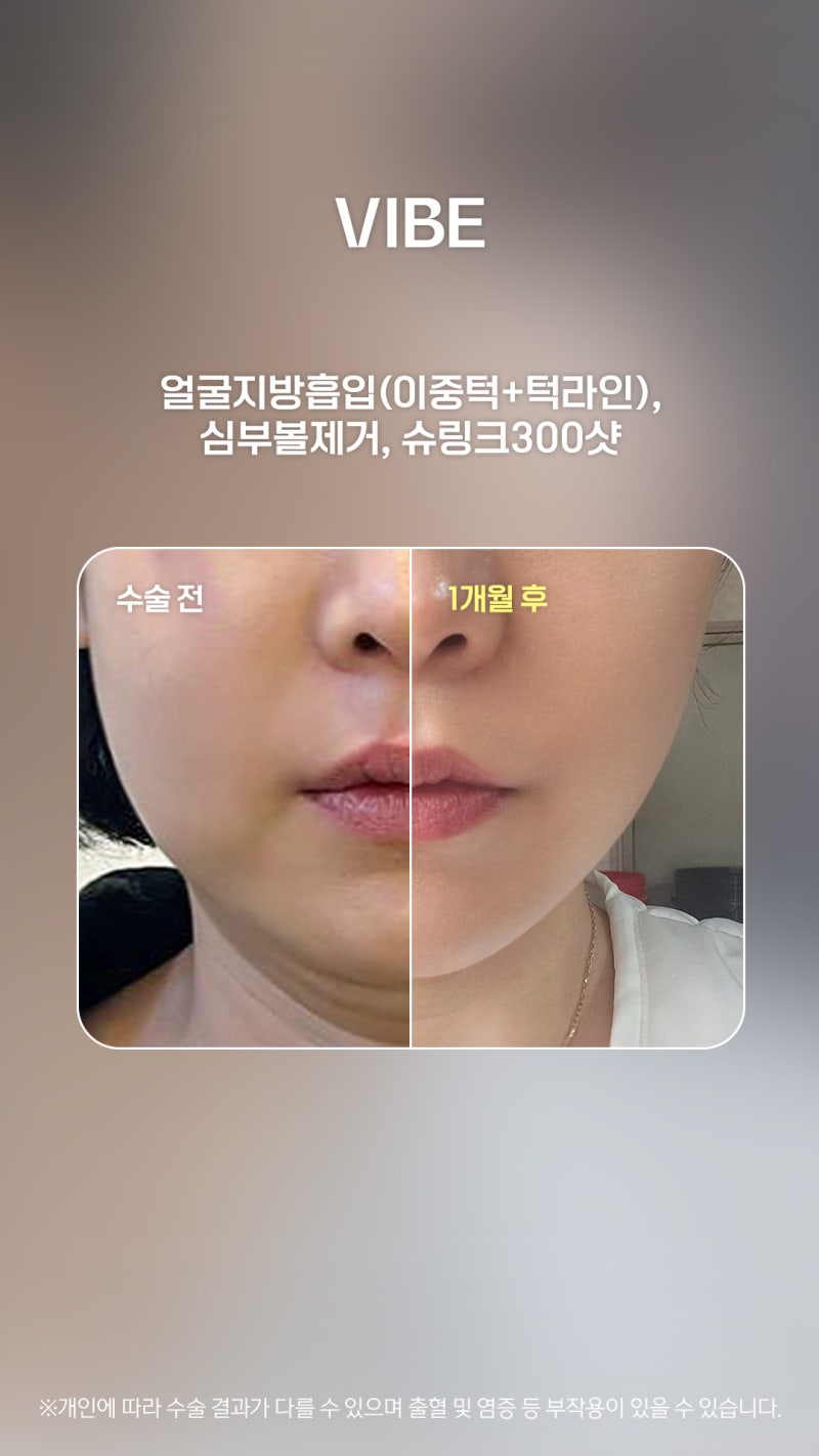 Stressed by a Sagging Double Chin and Buccal Fat? Try the Face Liposuction + Buccal Fat Removal + Shurink Combination