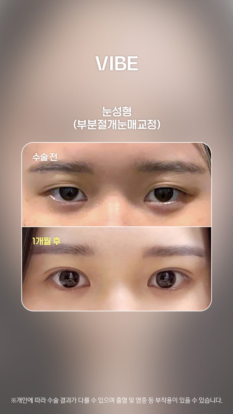 Menciptakan Mata Cantik dan Berbinar dengan Koreksi Kelopak Mata Insisi Parsial