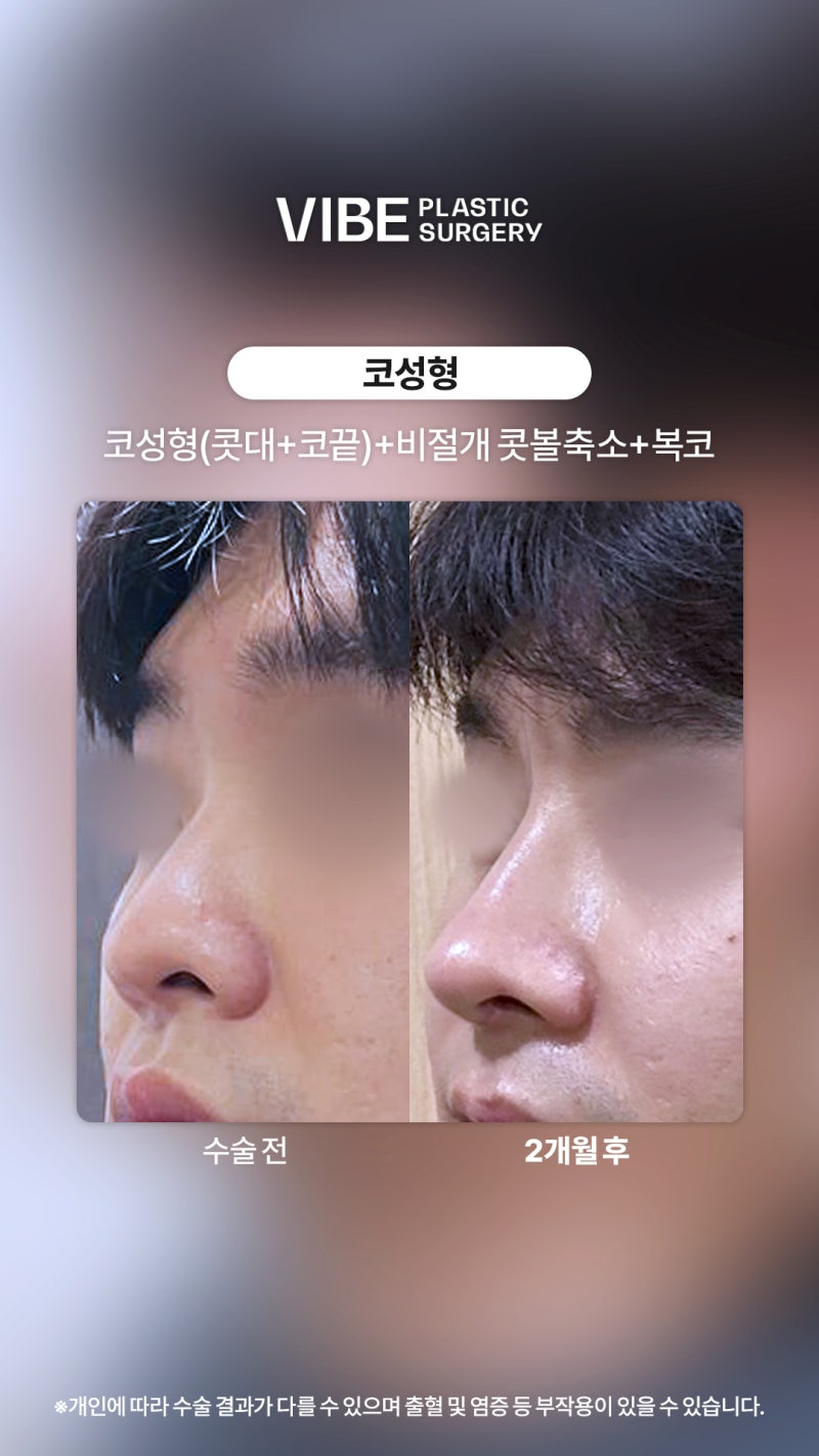 Male Rhinoplasty: Comparing Changes Before and 2 Months After Surgery