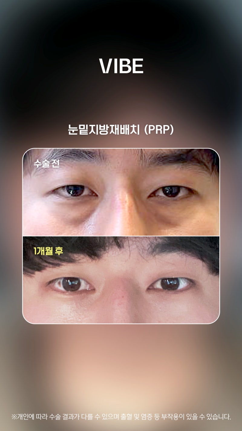 볼록한 눈밑고민! 눈밑지방재배치로 균일하게