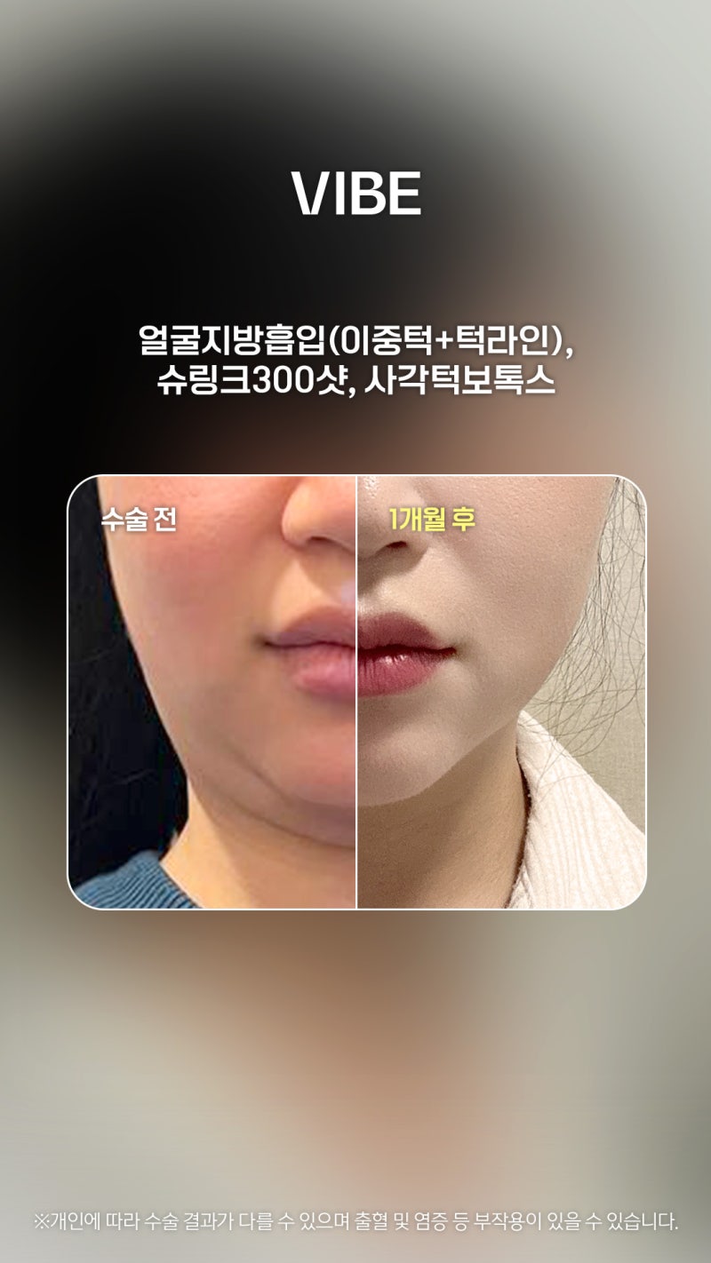 สร้างกรอบหน้าคมชัดด้วย LSSA นวัตกรรมดูดไขมันเหนียงด้วยคลื่นอัลตราซาวด์!