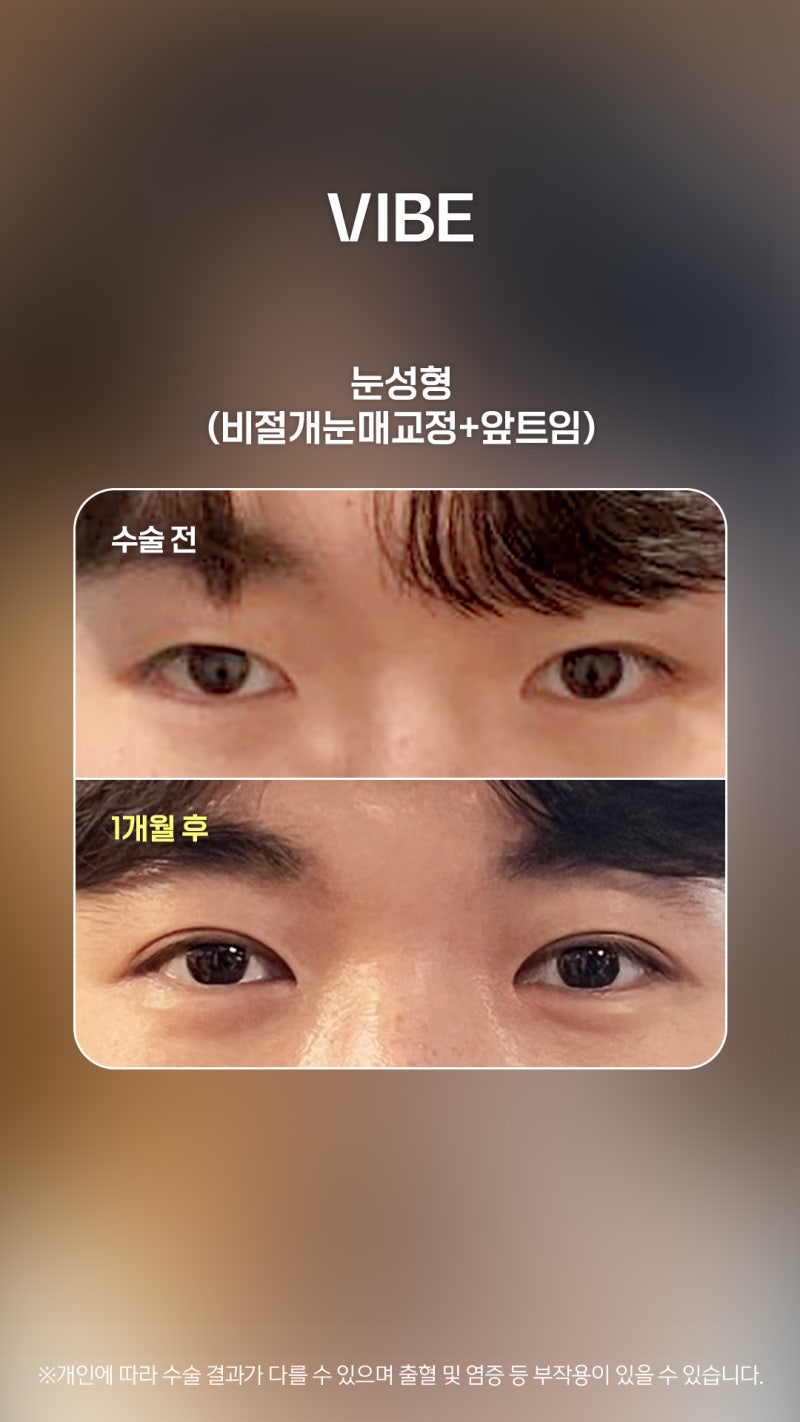 Achieve Clarity If You Have Sleepy and Weak Eyes!