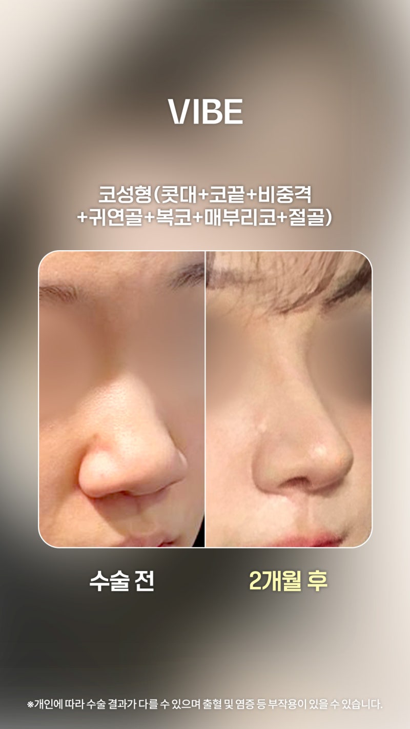 เปลี่ยนจมูกที่กว้างและหนาให้เป็นทรงสโลปปลายพุ่ง (Straight-Half-Ogee Line) สุดเป๊ะ!