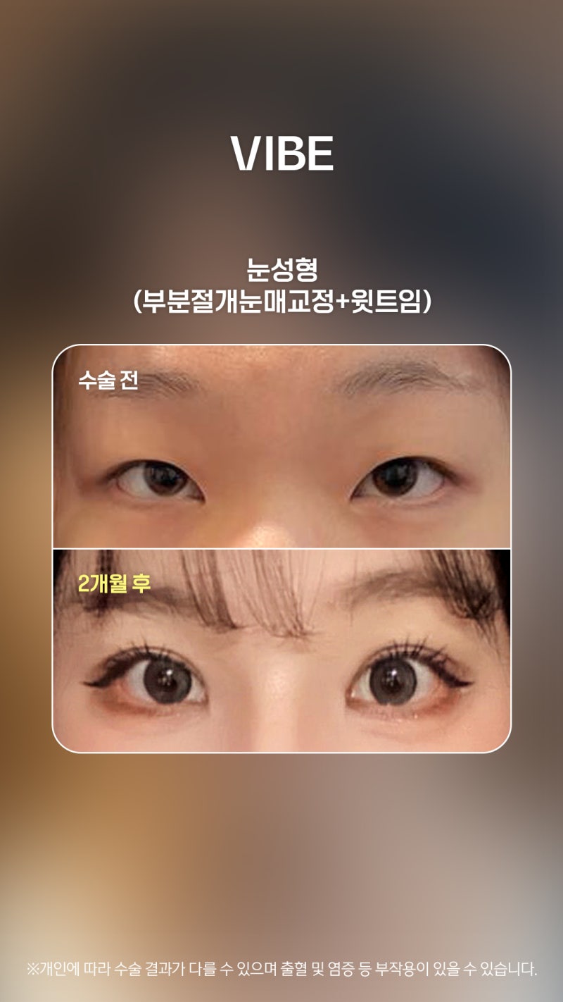 If You Constantly Use Your Forehead to Open Your Eyes, Consider Ptosis Correction