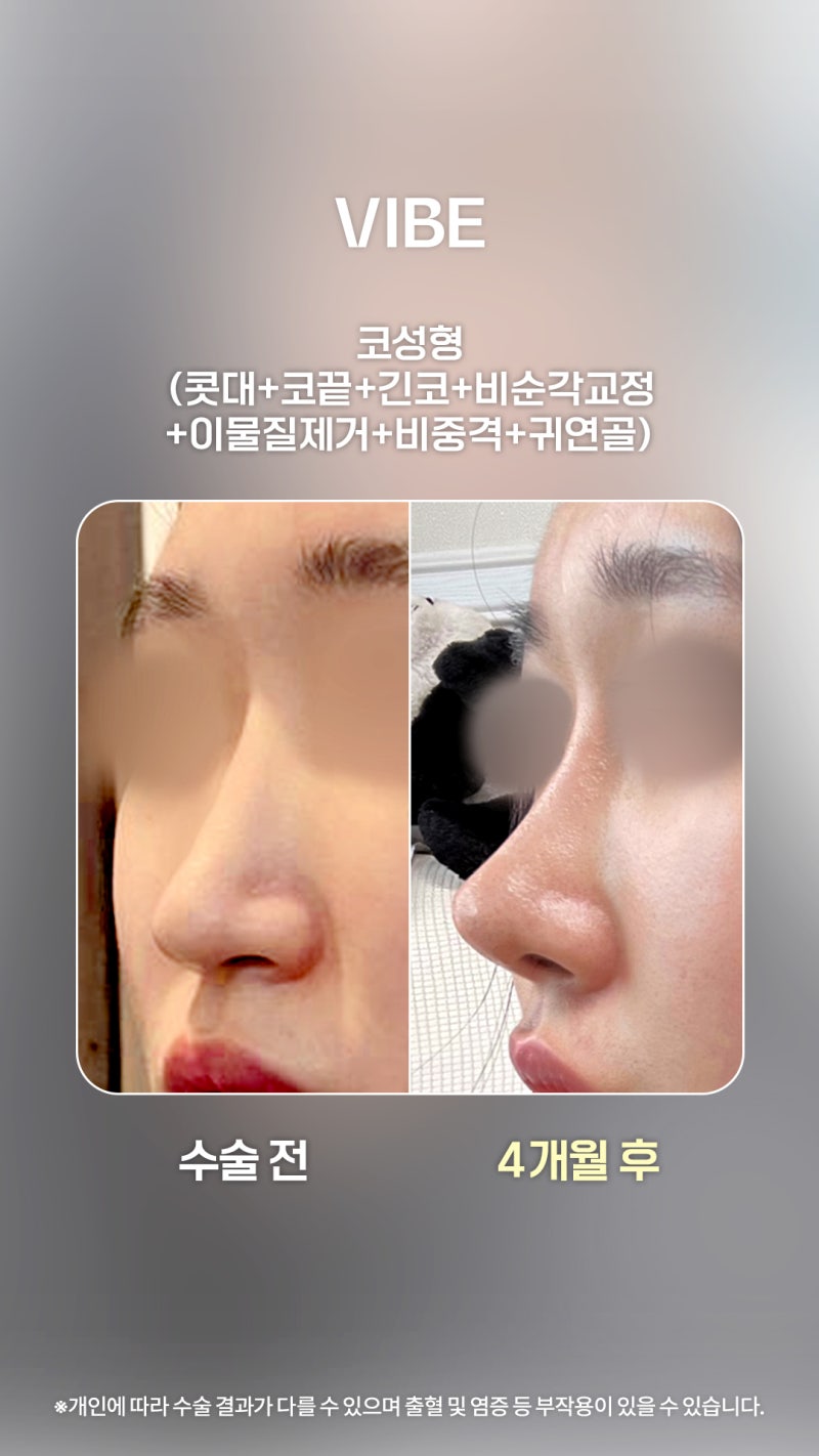Kasus Meninggikan Hidung dengan Operasi Setelah Sebelumnya Menggunakan Prosedur Non-Bedah!