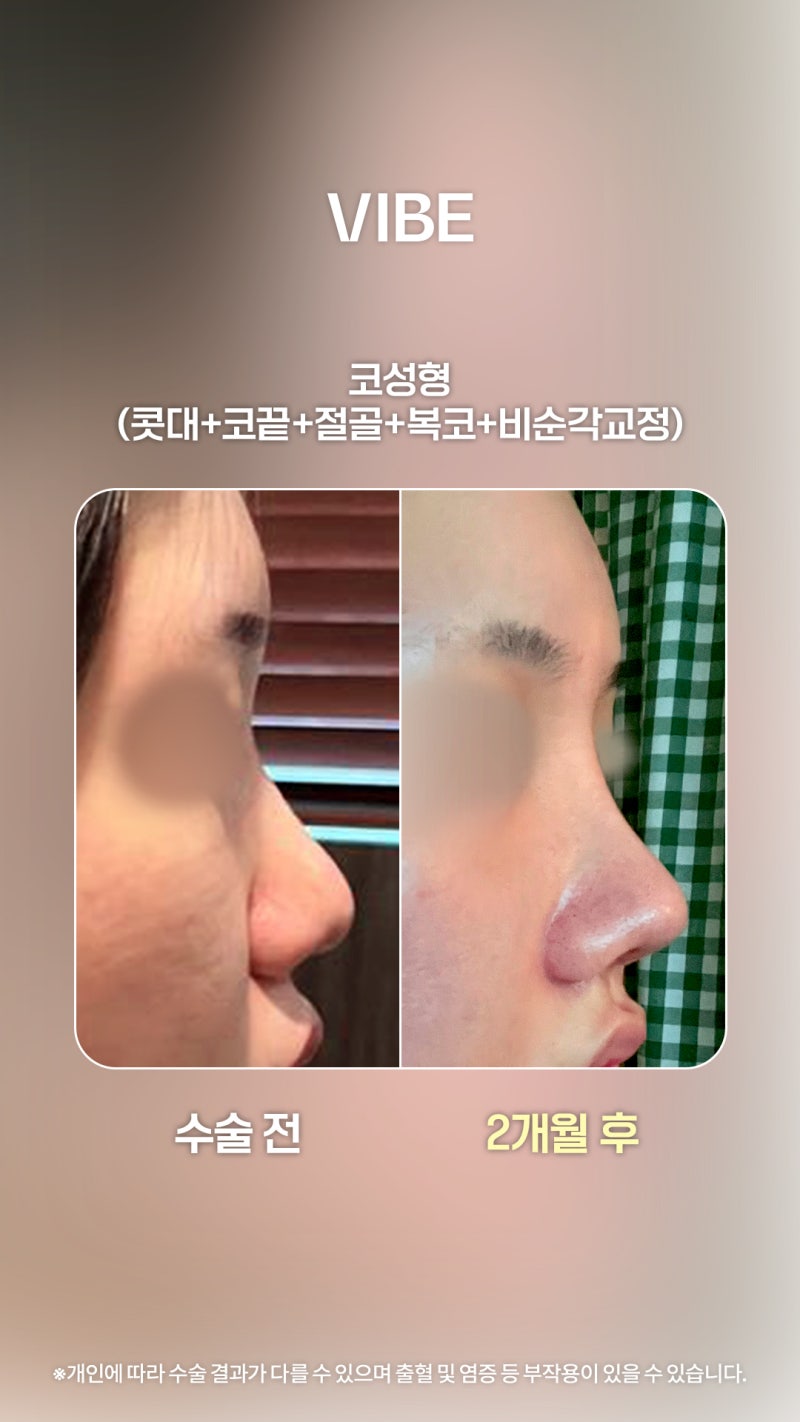 จากจมูกชมพู่หนาๆ สู่จมูกโด่งสวยสไตล์ Oh Yeon-seo!