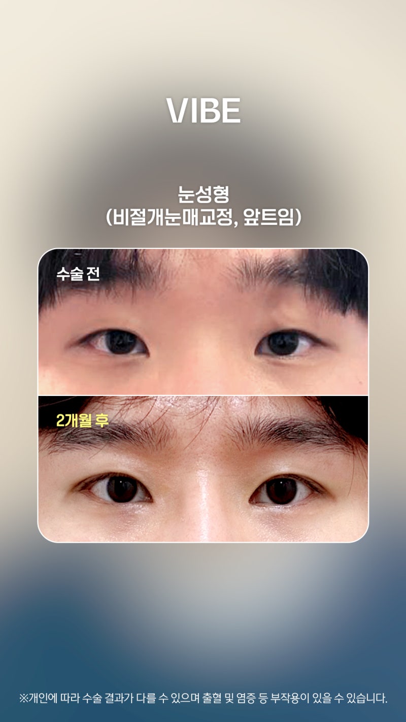 自然不显痕迹的男士眼部整形