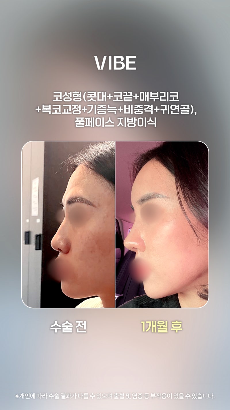 تحقيق خطوط وجه متناغمة من خلال تجميل الأنف وحقن الدهون في كامل الوجه