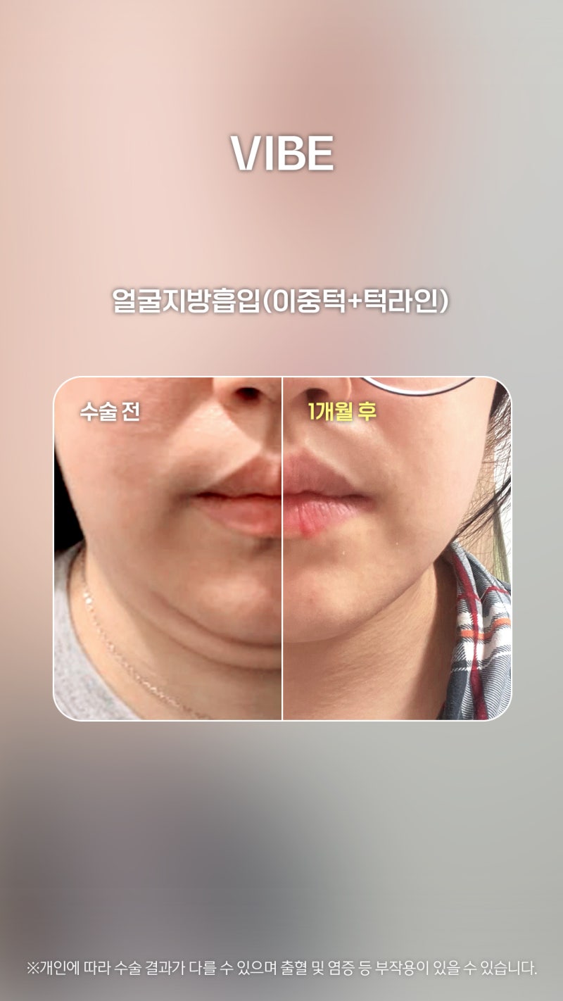 초음파 얼굴지흡으로 브이라인되세요