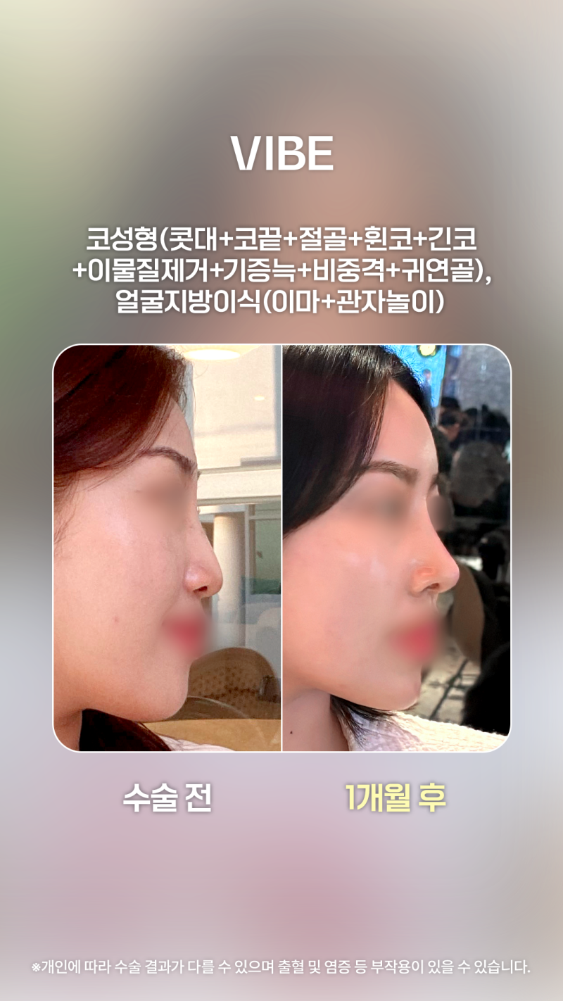 코성형과 얼굴지방이식으로 환상적인 라인!