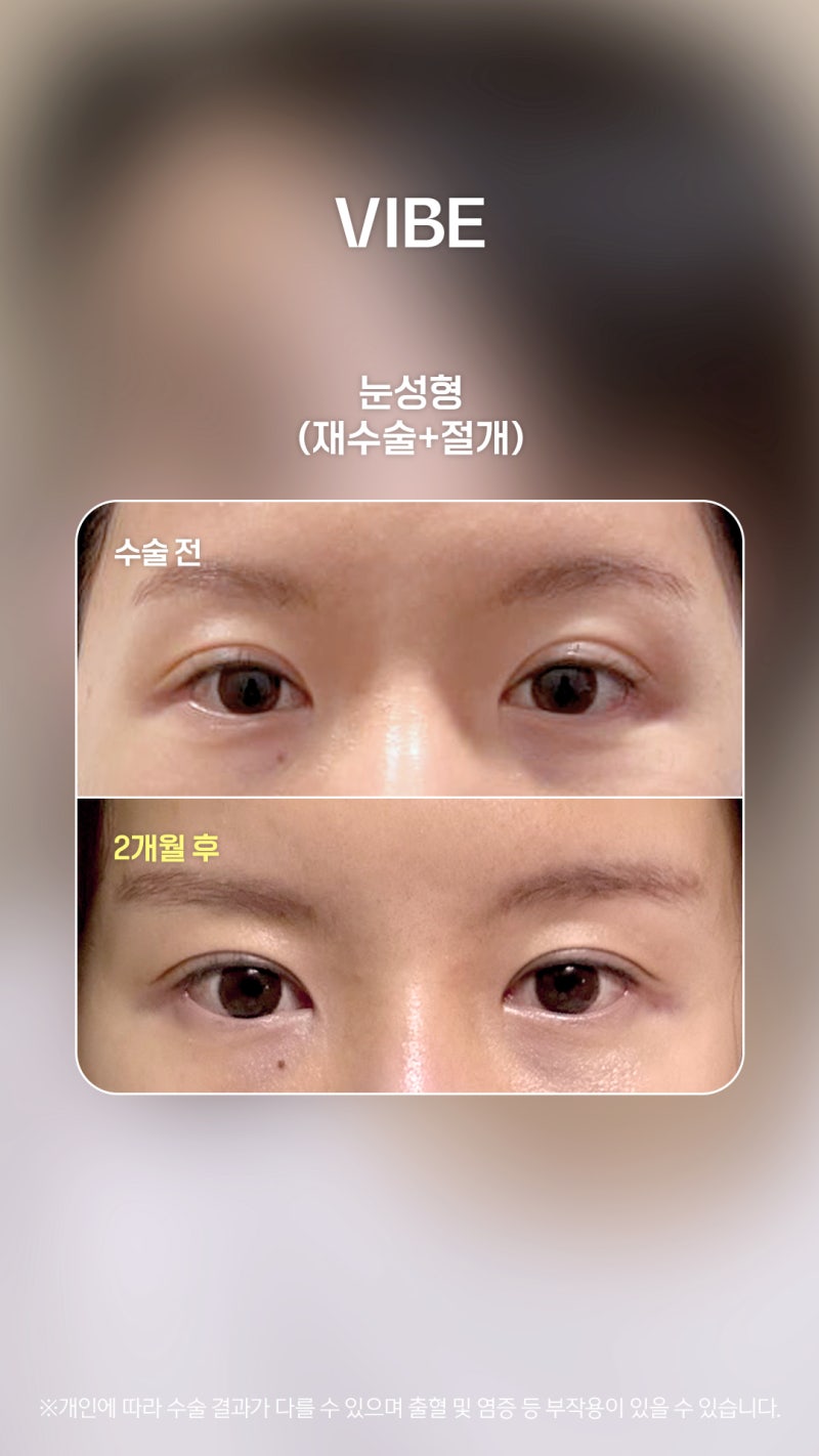 ชั้นตาไม่เท่ากัน แก้ไขให้เป๊ะด้วยการทำตาสองชั้นรอบที่ 3 ได้จริงหรือ?