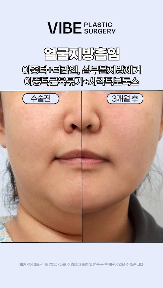 บอกลาคางสองชั้นหนาๆ! ปรับรูปหน้าให้เรียวสวยด้วย Liposound ดูดไขมันใบหน้า, ตัดไขมันกระพุ้งแก้ม และเย็บกล้ามเนื้อใต้คาง