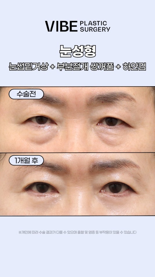 擔心眼部下垂？透過中年眼部整形改善