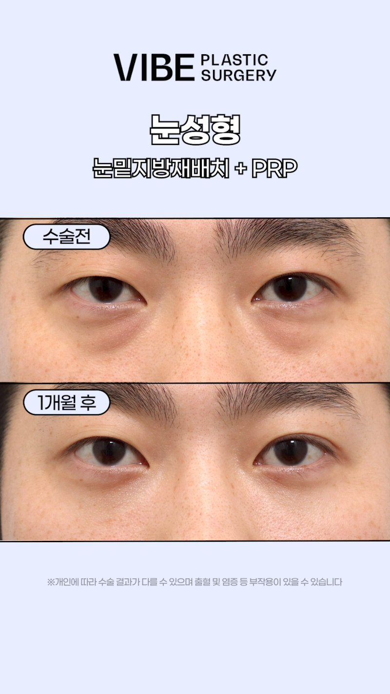 피곤하고 어두워보이는 인상, 눈밑때문이라면?