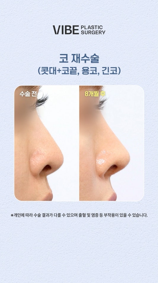 حالة مراجعة عملية تجميل الأنف: تصحيح الأنف الطويل وفتحات الأنف المرتفعة (أنف التنين)