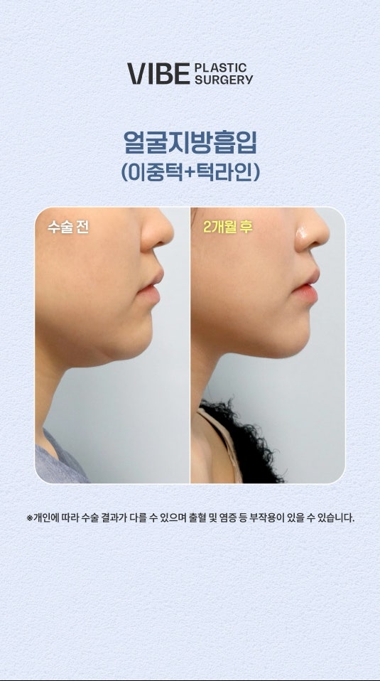 얼굴지방흡입 엘싸(LSSA)로 브이라인 완성