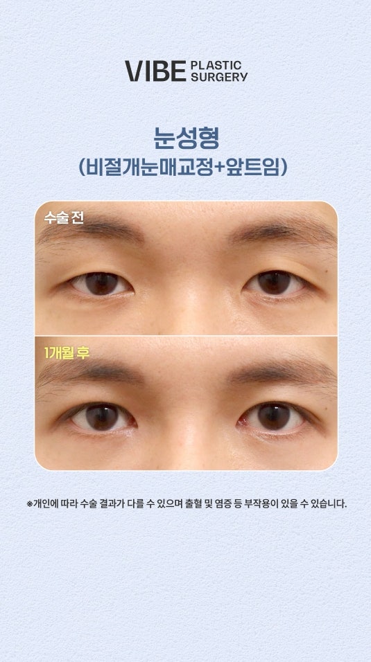 비절개눈매교정, 앞트임으로 졸린눈을 또렷하게!