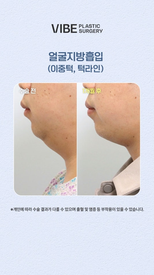 비수술지방흡입 엘싸(LSSA)로 이중턱지방을 쏙쏙 빼보자