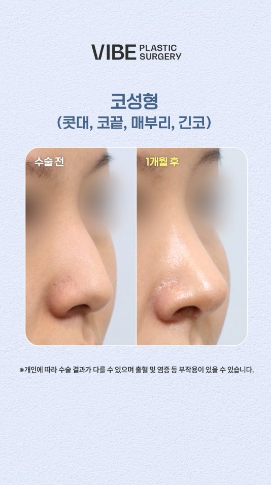 길고 처진 코끝케이스 무보형물로 예쁘게