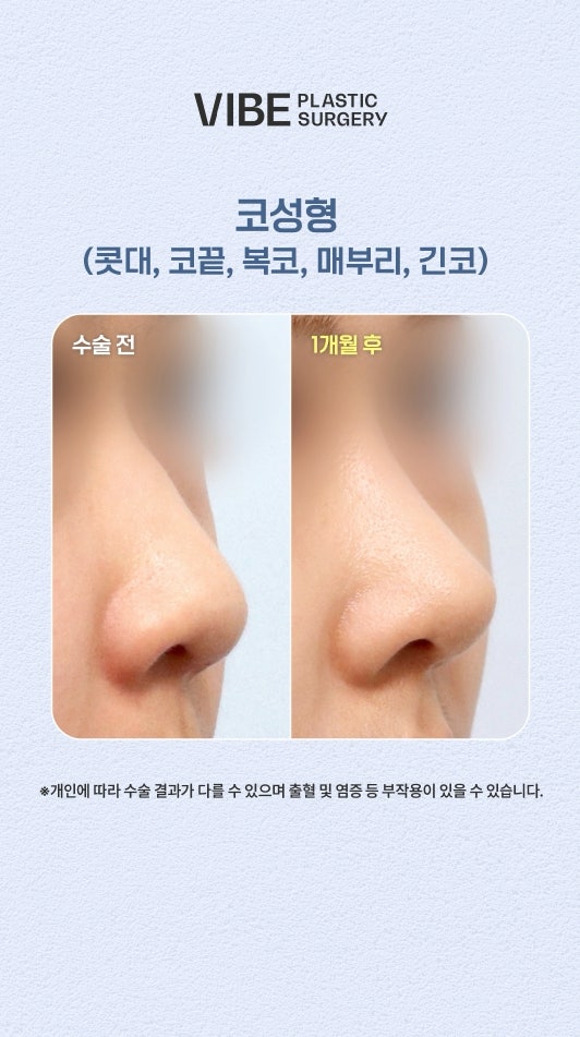 복코+매부리코+긴코 교정 전후