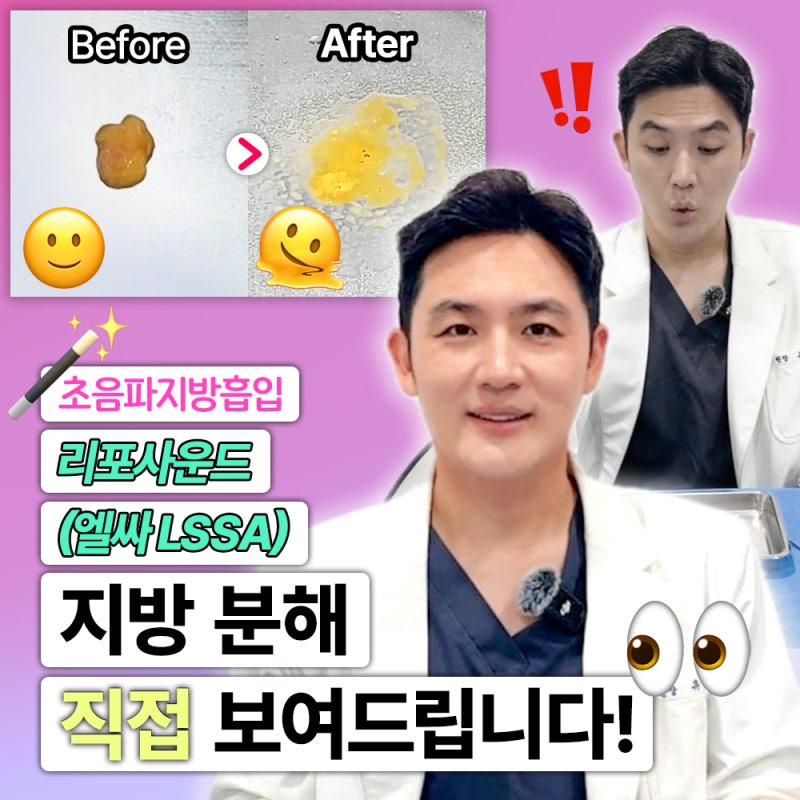 신논현 이중턱지방흡입 리포사운드 엘싸(LSSA) | 초음파 지방분해과정 바이브성형외과에서 알아봐요