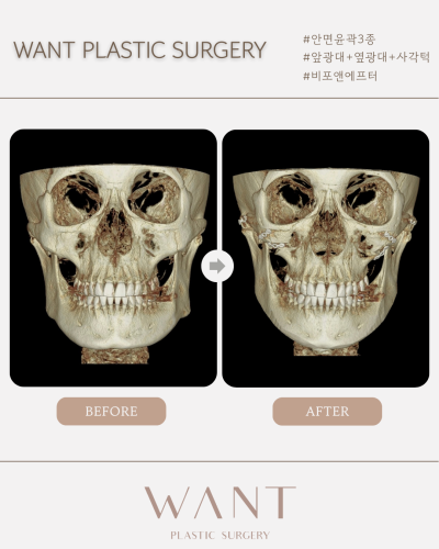 강남 안면윤곽 잘하는곳 찾는다면 사진 4