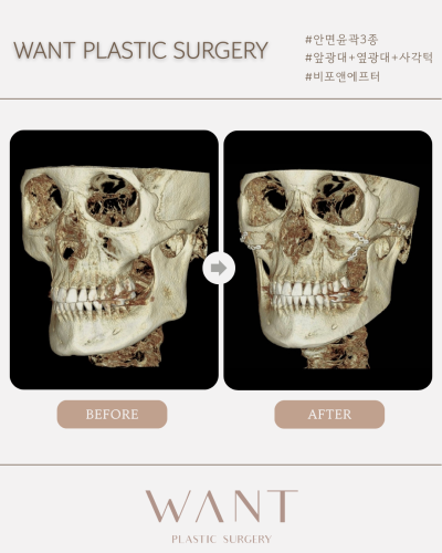 조화로운 안면윤곽 결과를 위한 사진 7