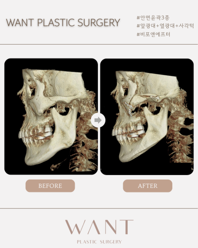 조화로운 안면윤곽 결과를 위한 사진 8