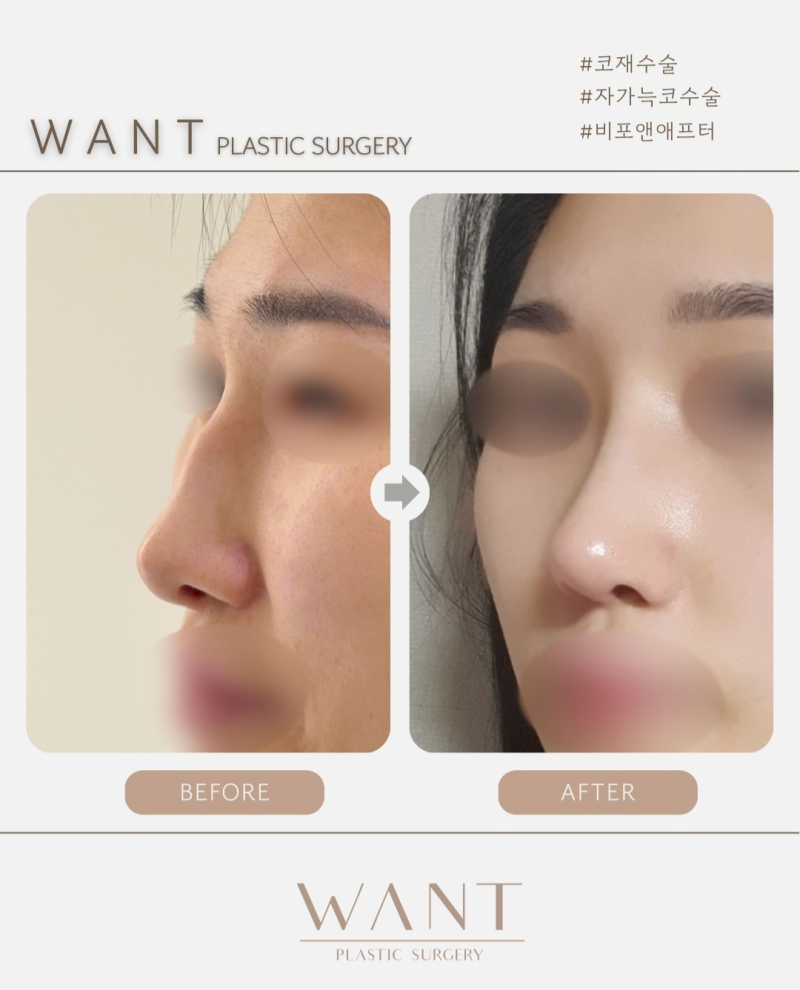 코재수술 시기 언제가 좋을까? 코성형 부작용 증상과 대처법 총정리! 사진 8