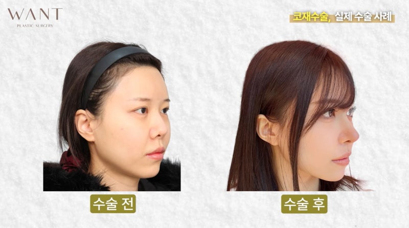 코재수술 몇 번까지 가능할까? 반복수술 위험성과 흉살, 실제 회복 경과 후기! 사진 8