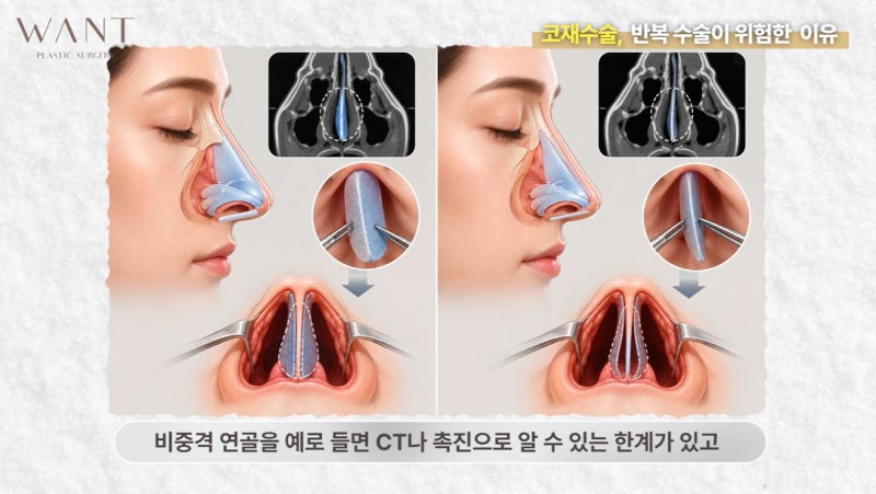 코재수술 몇 번까지 가능할까? 반복수술 위험성과 흉살, 실제 회복 경과 후기!