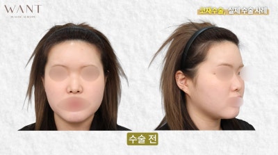코재수술 몇 번까지 가능할까? 반복수술 위험성과 흉살, 실제 회복 경과 후기! 사진 6