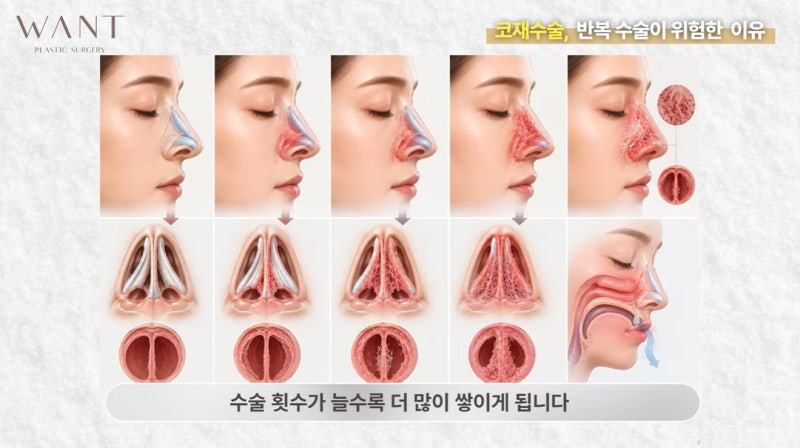 코재수술 몇 번까지 가능할까? 반복수술 위험성과 흉살, 실제 회복 경과 후기! 사진 3