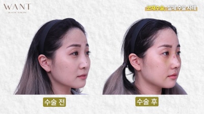 코재수술 몇 번까지 가능할까? 반복수술 위험성과 흉살, 실제 회복 경과 후기! 사진 4