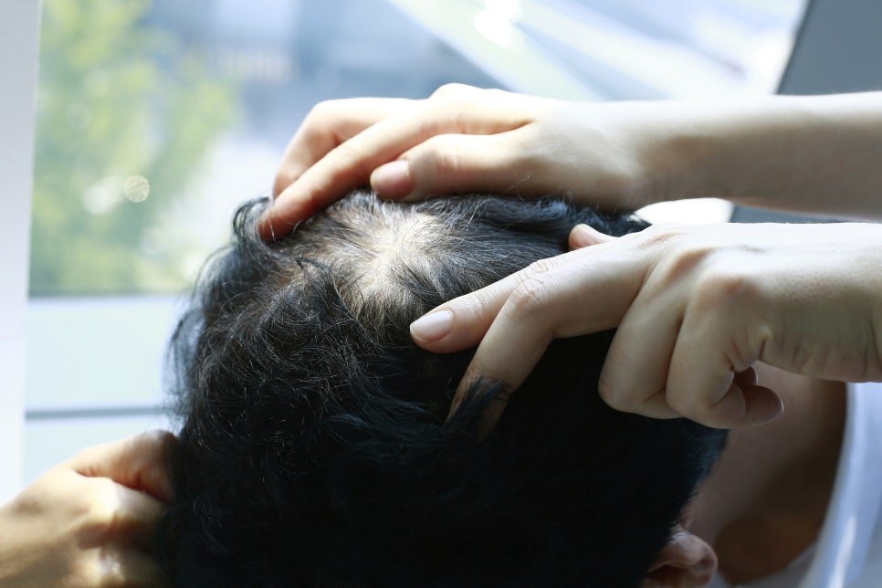 빠지는 머리카락, 인천 탈모치료로 안심하고 관리하세요 사진 10