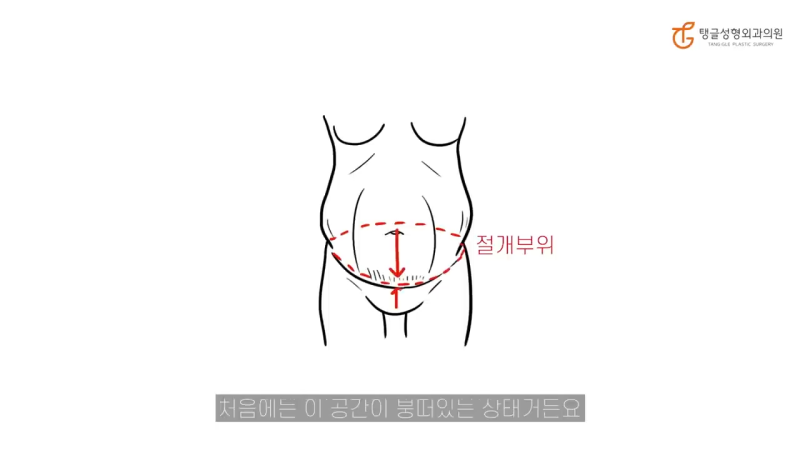 Abdominoplasty: Sagging Belly Fat Isn't Just a Fat Problem 사진 3