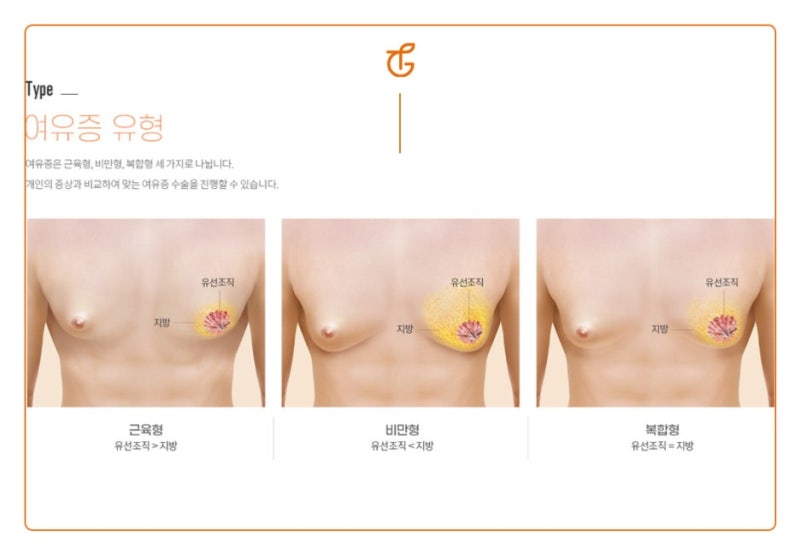 Gynecomastia: Causes and Treatment! 사진 5