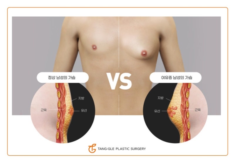 Gynecomastia: Causes and Treatment! 사진 4