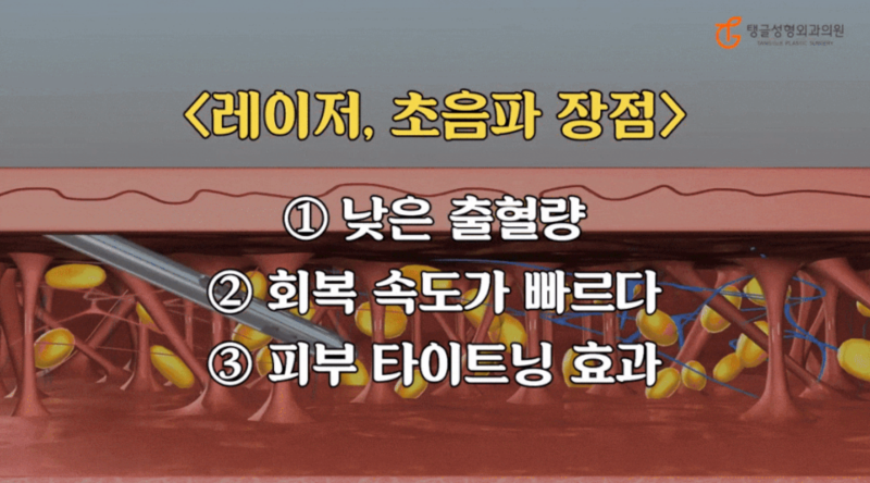 Diet Sagging Skin: Not the Right Answer for Everyone 사진 2