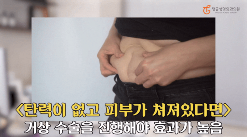 Diet Sagging Skin: Not the Right Answer for Everyone 사진 3
