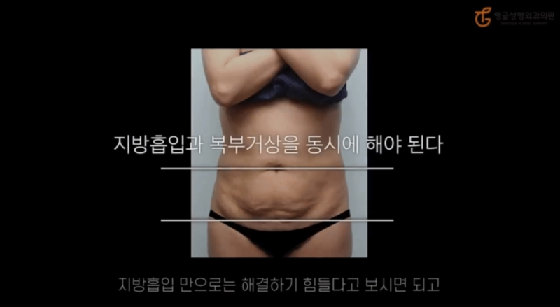 복부지방흡입잘하는곳, 수술 전 확인해야 할 5가지 사진 4
